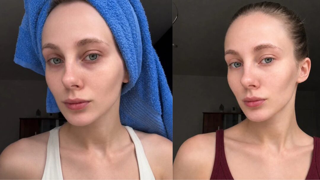Before and after Peptina: vascular dark circles faded